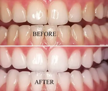 25279 hydrogen peroxide teeth whitening 2