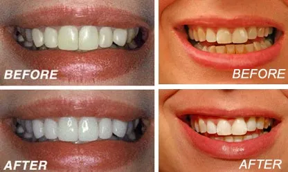 25279 hydrogen peroxide teeth whitening 3