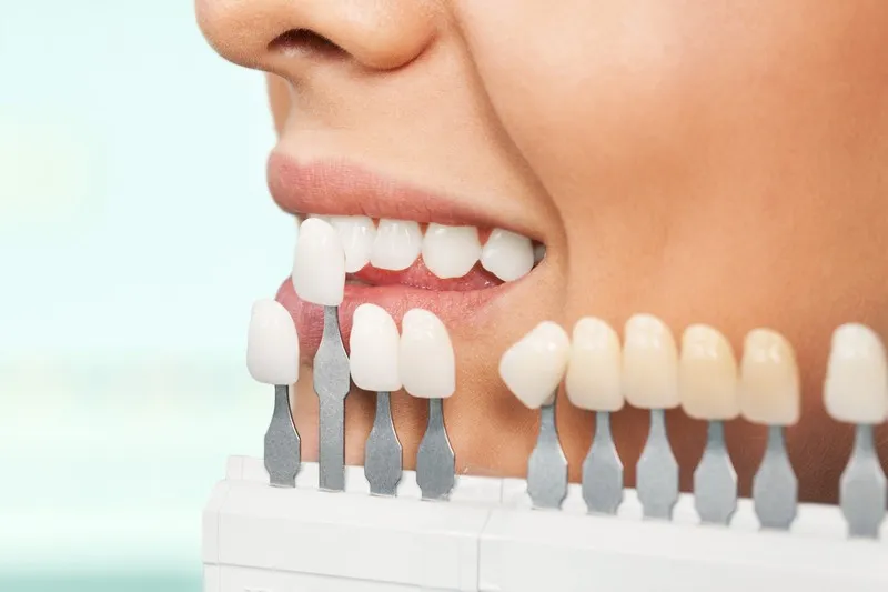 /img/25279-hydrogen-peroxide-teeth-whitening-7.webp