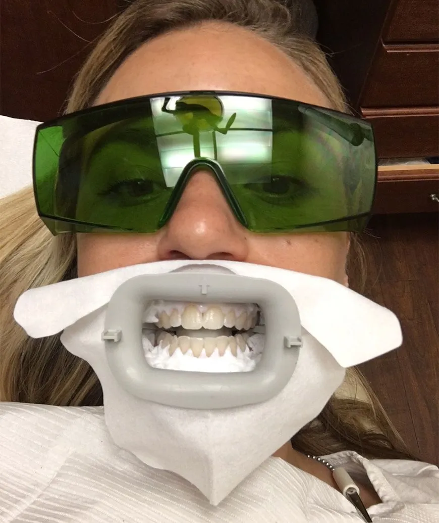 25281 at home teeth whitening