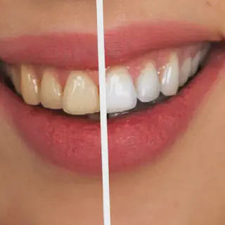 /img/25281-maintaining-white-smile.webp