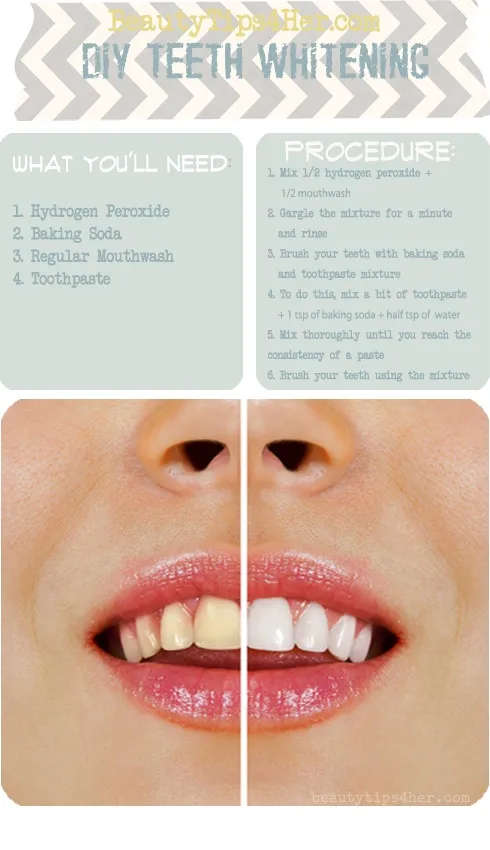 25281 professional teeth whitening
