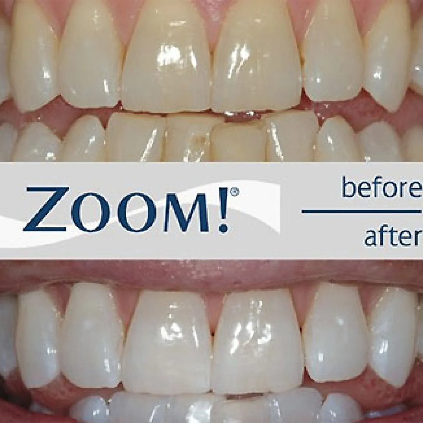 25285 zoom teeth whitening cost factors