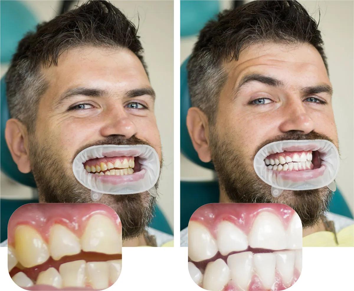 25285 zoom teeth whitening dentist