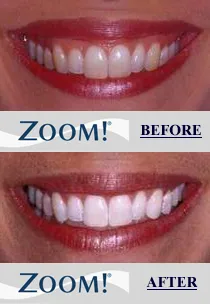 25285 zoom teeth whitening insurance
