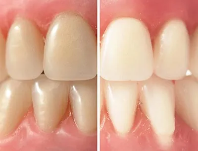 25290 at home teeth whitening
