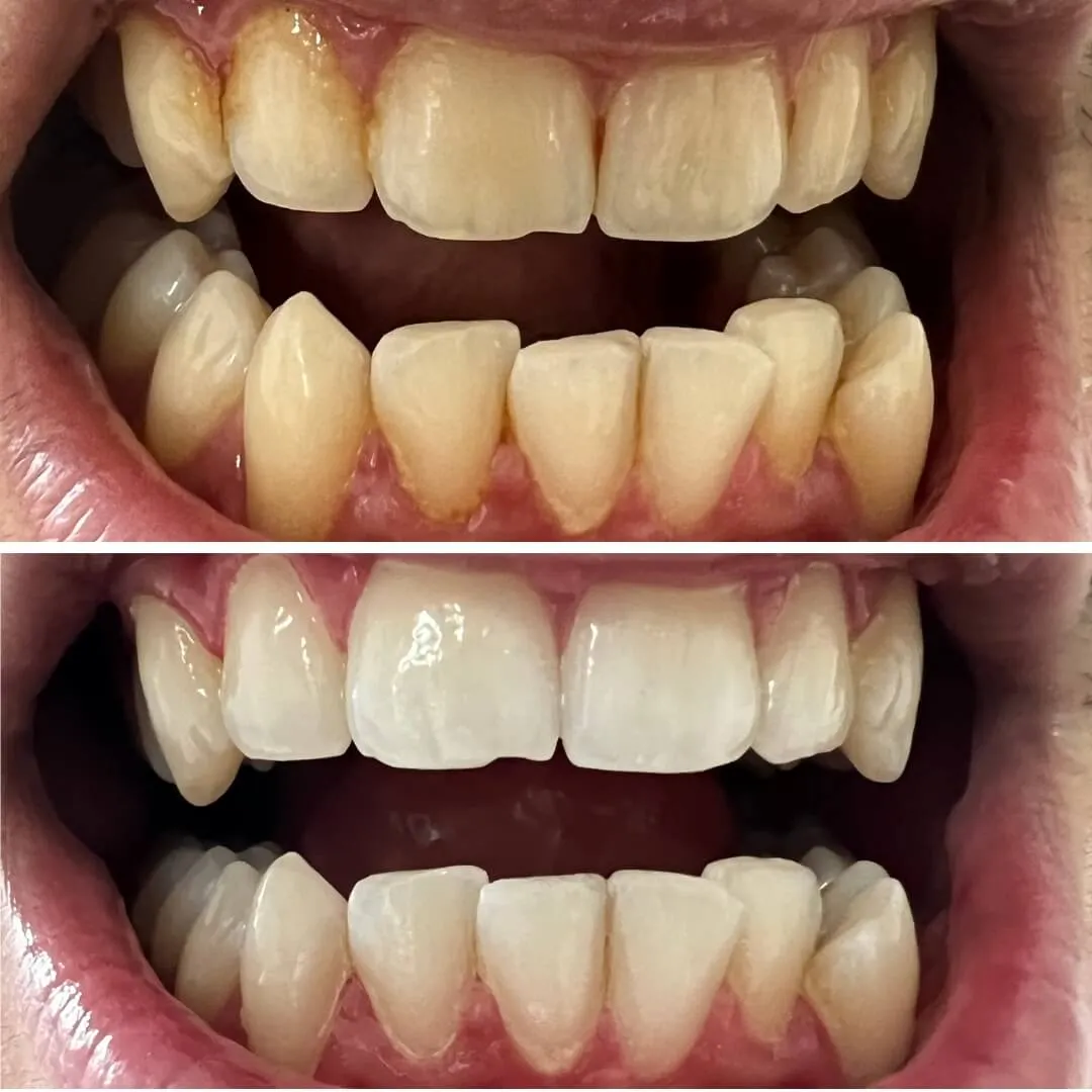 25296 baking powder teeth whitening 5