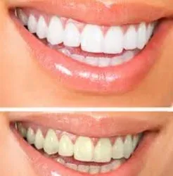25297 at home teeth whitening