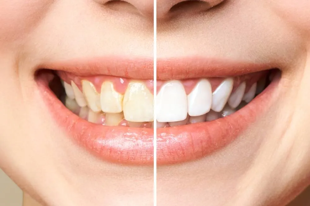 25297 professional teeth whitening
