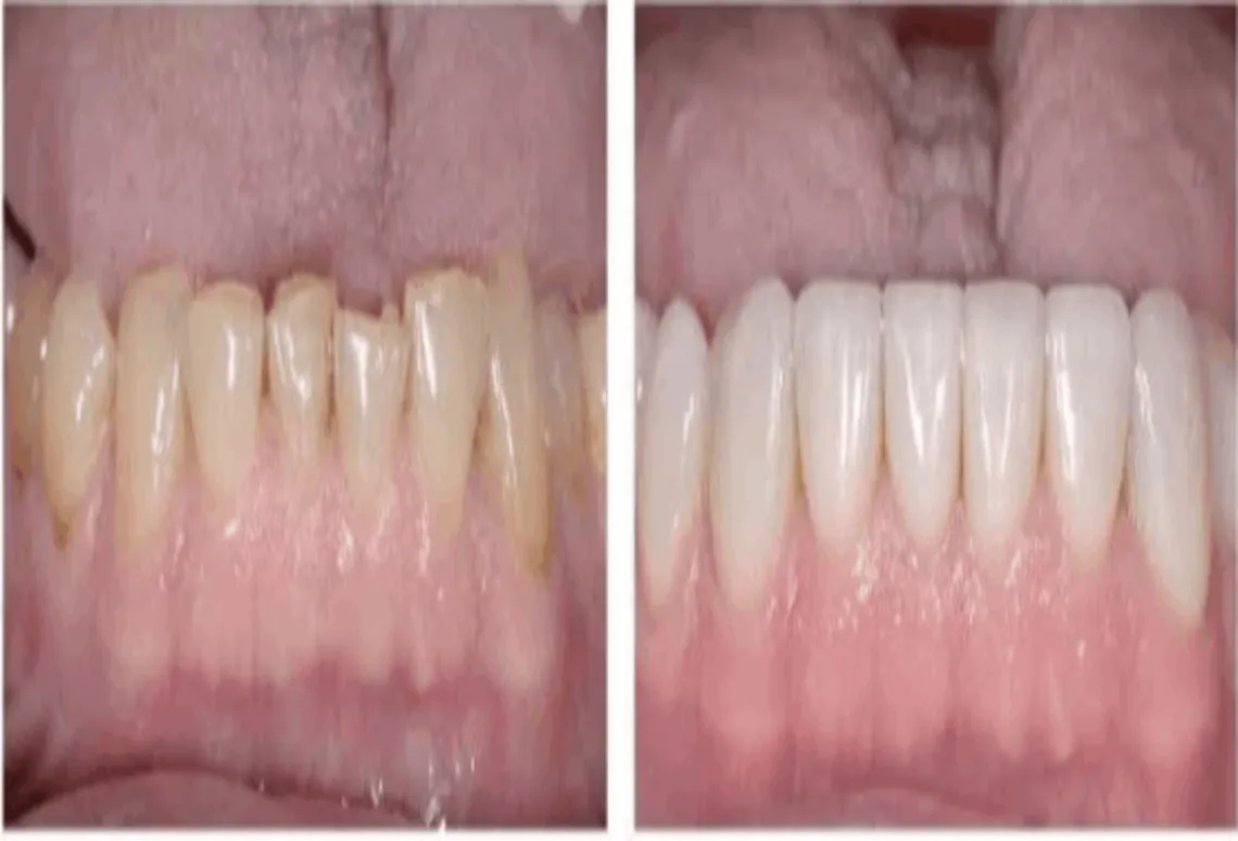 25297 teeth whitening options